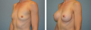 Breast Augmentation Patient 1