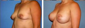 Breast Augmentation Patient 10