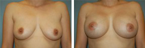 Breast Augmentation Procedure Patient 11