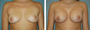 Breast Augmentation Procedure Patient 12