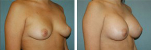 Breast Augmentation Procedure Patient 12