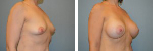 Breast Augmentation Procedure Patient 2