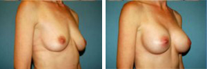 Breast Augmentation Procedure Patient 3