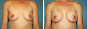 Breast Augmentation Procedure Patient 3