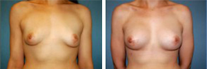 Breast Augmentation Procedure Patient 4
