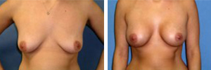 Breast Augmentation Procedure Patient 5