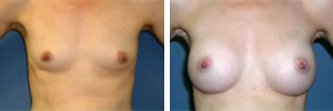 Breast Augmentation Procedure Patient 6