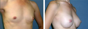 Breast Augmentation Procedure Patient 6