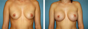 Breast Augmentation Procedure Patient 7