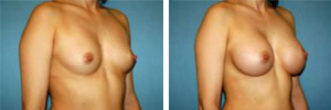 Breast Augmentation Procedure Patient 7