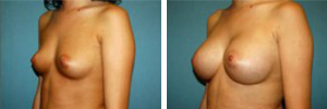 Breast Augmentation Procedure Patient 8