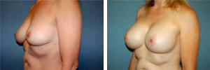 Breast Augmentation Procedure Patient 9