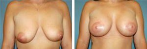 Breast Lift Procedure Patient 1