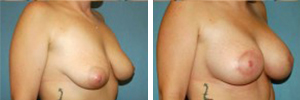 Breast Lift Procedure Patient 1