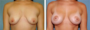 Breast Lift Procedure Patient 2