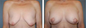 Breast Lift Procedure Patient 3