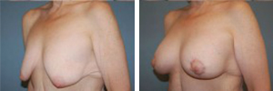 Breast Lift Procedure Patient 3