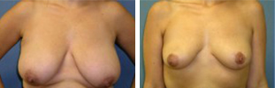 Breast Reduction Procedure Patient 1