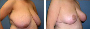 Breast Reduction Procedure Patient 2