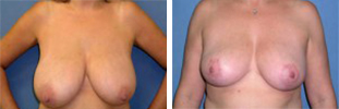 Breast Reduction Procedure Patient 3