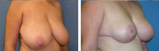 Breast Reduction Procedure Patient 3