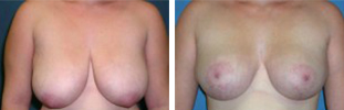 Breast Reduction Procedure Patient 4