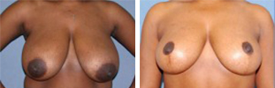Breast Reduction Procedure Patient 5