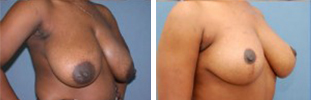 Breast Reduction Procedure Patient 5