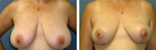 Breast Reduction Procedure Patient 6