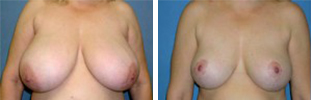 Breast Reduction Procedure Patient 7