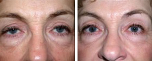 eyelid lift procedure patient 3