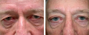 eyelid lift procedure patient 2