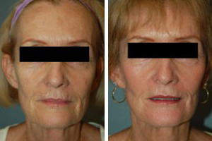 Face Lift Procedure