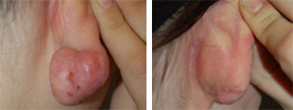 Keloid Removal Procedure Patient 6