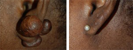 Keloid Removal Procedure Patient 8