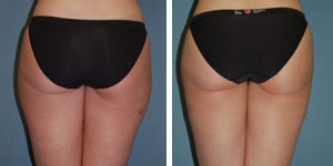 Liposuction Procedure Patient 1