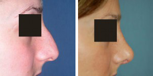 Rhinoplasty Procedure Patient 2