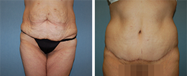 Tummy Tuck Procedure Patient 4