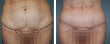 Tummy Tuck Procedure Patient 8