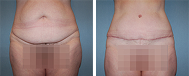 Tummy Tuck Procedure Patient 9